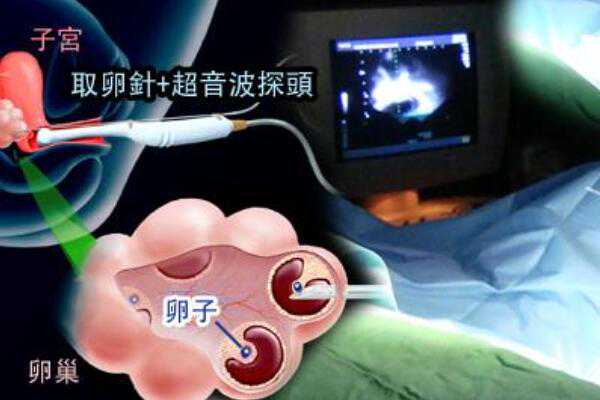 合肥想要孩子找代孕可靠吗,试管婴儿的详细过程是怎么样_上海正规供卵试管婴